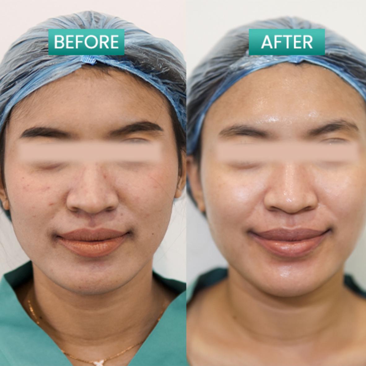 Before After Pore xSome PDRN DNA Salmon